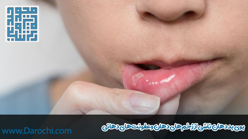 بوی بد دهان ناشی از زخم‌های دهان وعفونت‌های دهانی