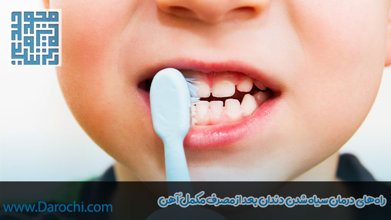 درمان سیاهی دندان بر اثر قطره آهن