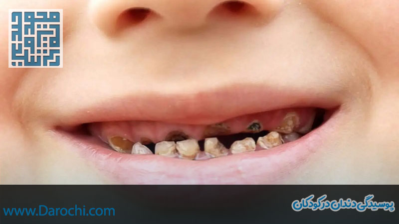 پوسیدگی دندان در کودکان