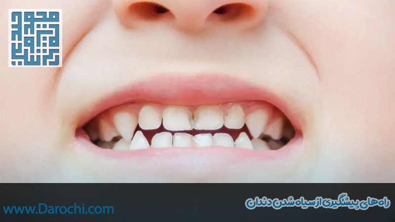 راه های پیشگیری از سیاه شدن دندان کودکان