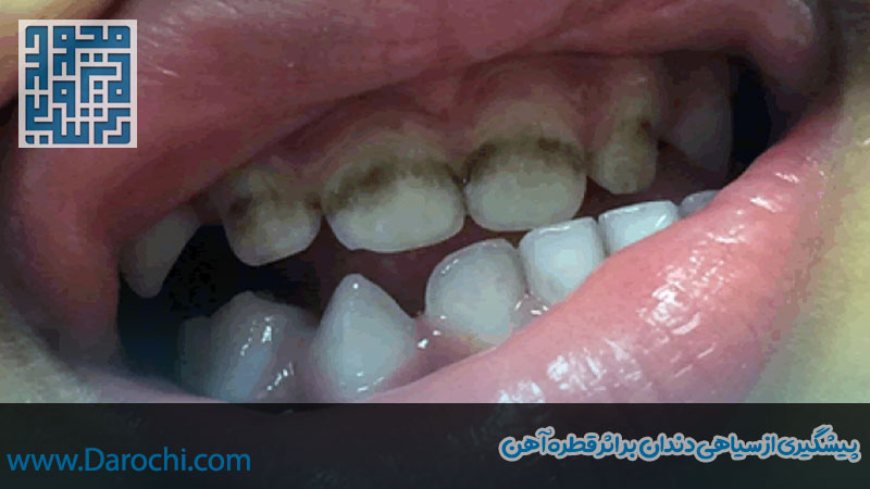 پیشگیری از سیاهی دندان بر اثر قطره آهن