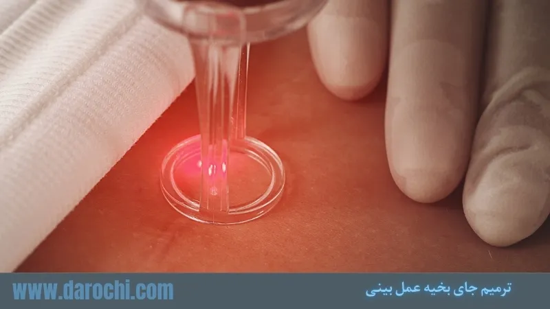 ترمیم جای بخیه عمل بینی - از بین بردن جای بخیه، زمان ترمیم و بهترین روشهای درمان