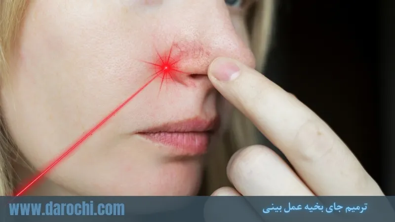ترمیم جای بخیه عمل بینی - از بین بردن جای بخیه، زمان ترمیم و بهترین روشهای درمان